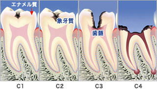 むし歯の進行度合い